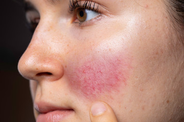 A young caucasian woman is seen closeup and from the side, pointing towards her red flushing cheek with blotches and dilated blood vessels, al symptomatic of rosacea - obrazy, fototapety, plakaty