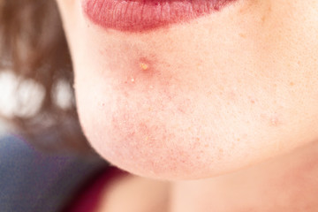 A close-up view on a pus filled pimple on the chin of a young caucasian woman, detailed view of...