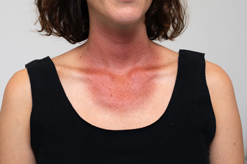 A closeup view of the red tan line around the neck and chest of a female, at risk of skin cancer...