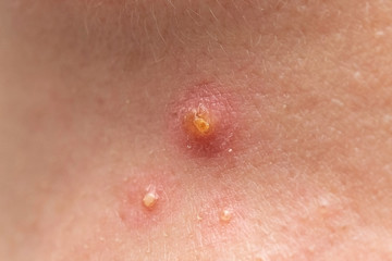 A close up view of pus filled spots on caucasian skin, clustered together, similar to that of the herpes simplex virus.