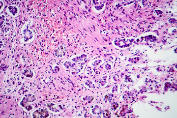 Small nodular cirrhosis, light micrograph, photo under microscope