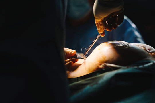 Plastic surgeon sewing up breast of female patient after inserting implants in operating room