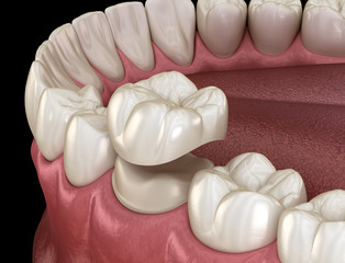 Preparated molar tooth for dental crown placement. Medically accurate 3D illustration