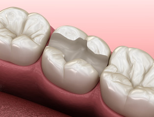 Tooth preparation for inlay placement. Medically accurate 3D illustration of human teeth treatment