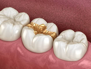 Golden Inlay crown fixation over tooth. Medically accurate 3D illustration of human teeth treatment
