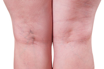 Varicose veins closeup, fat female legs isolated on white background