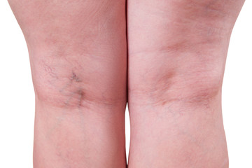 Varicose veins closeup, fat female legs isolated on white background