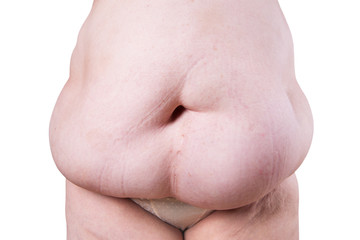 Fototapeta premium Tummy tuck, flabby skin on a fat belly, plastic surgery concept isolated on white background