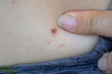 A mother inspects a small red rash on child's skin. Worried mom checks the skin of infant, seen close up in macro view. Healthcare and parenthood concepts.