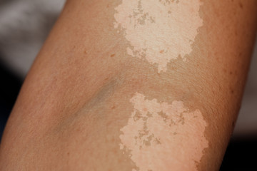 A closeup view on the arm of a person suffering from tinea versicolor, a fungal infection of...