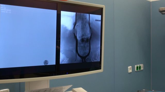 monitor with X-rays of the spine during surgery