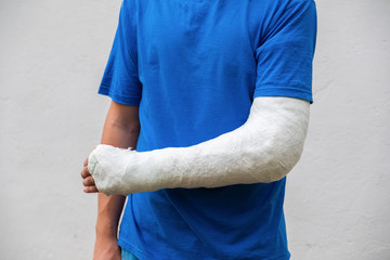 Man with broken arm wrapped medical cast plaster. Fiberglass cast covering the wrist, arm, elbow...
