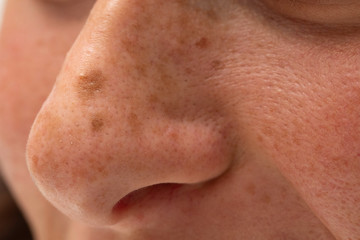 Moles and freckles are seen close up in macro detail, on the nose of a caucasian person, fair skin with open pores at risk of skin cancer and disease.