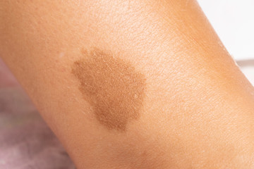 A closeup view of a large brown benign irregularity on the skin of a person, birthmark on the leg...