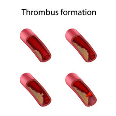 Thrombus formation. Stages. Vector medical anatomy illustration.