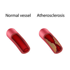 Atherosclerosis and normal vessel, comparison. Vector medical anatomy illustration.