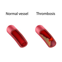 Thrombosis and normal vessel, comparison. Vector medical anatomy illustration.