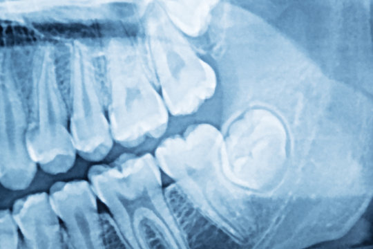 panoramic dental x-ray of a mouth left  side.