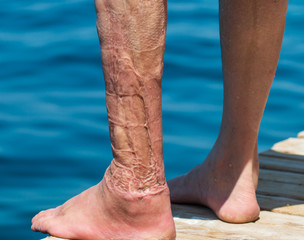 thermal burn on the male foot