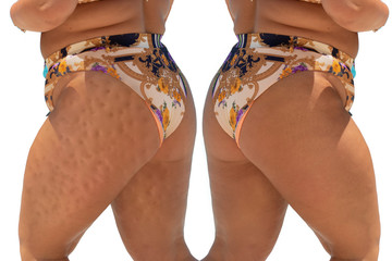 Before and after view on a confident woman who underwent successful treatment to remove orange peel...