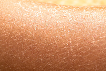 A closeup view of dry and arid skin, severely cracked and tight from spending too much time under...