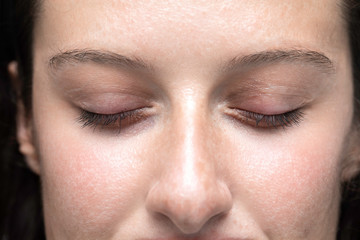 A young woman is viewed up close as she closes her eyelids, revealing swelling a redness from a bacterial infection of staphylococcus aureus.