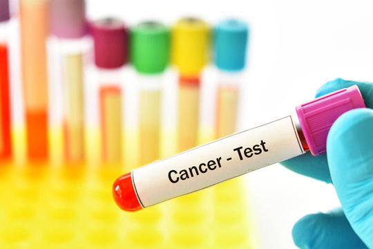 Blood sample tube for cancer or tumor marker test
