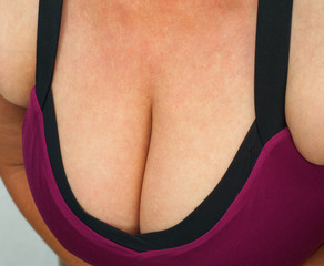 Adipositas Frau