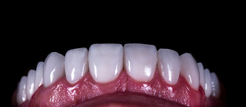 full mought recovery by press ceramic veneers