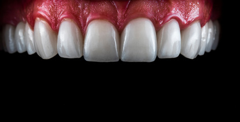 full mought recovery by press ceramic veneers