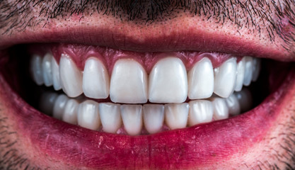 full mought recovery by press ceramic veneers