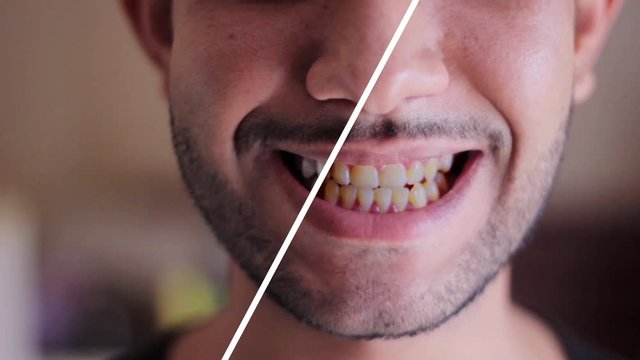 Smiling man before and after teeth whitening procedure