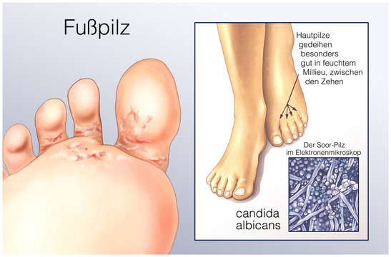 Fusspilz.Candida albicans