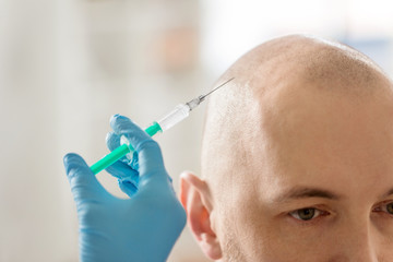 medicine, mesotherapy and cosmetic surgery concept - close up of cosmetologist's or doctors's hands with syringe making injection of hair growth serum to bald male head skin