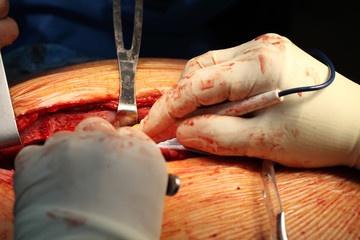 Close-up of surgeon's hands with operating tools at the surgical field