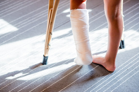 girl with a broken leg .close-up of feet, one with a plaster bandage. foot splint for treatment of injuries from broken bones. ankle sprain after jumping on the trampoline