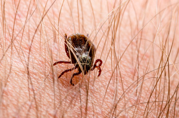 Lyme Disease Infected Tick Insect Crawling on Skin. Encephalitis Virus or Lyme Borreliosis Disease Infectious Dermacentor Tick Arachnid Parasite Macro.