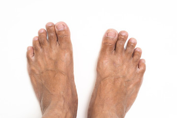 Asian man foot brown and dry skin