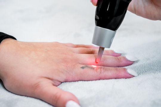 Picosecond laser tattoo removal on a small black tattoo on a patient's finger, in a skincare clinic, with a beautician administering the laser pulses.