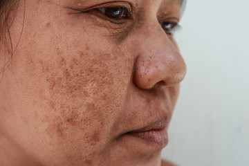 Skin problem, Closeup skin face asian women with spot melasma,  Dark spots, freckles, pigmentation  Skincare problem concept.