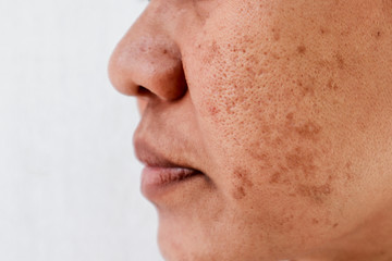Skin problem, skin face asian women with spot melasma,  Dark spots, freckles, pigmentation ...