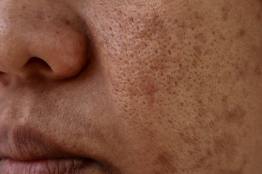 Skin Problem, Closeup Skin Face Asian Women With Spot Melasma,  Dark Spots, Freckles, Pigmentation  Skincare Problem Concept.