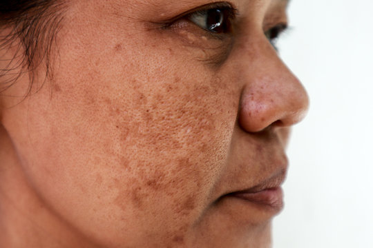 Skin problem, Closeup skin face asian women with spot melasma,  Dark spots, freckles, pigmentation  Skincare problem concept.