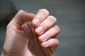 a woman's hand with badly damaged unhealthy nails after an incompetent, unprofessional removal of a hybrid or gel manicure, closeup