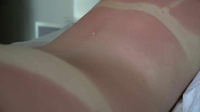 Young woman with red sunburned skin on her back. Putting sunburn lotion on the back. Red sunburned skin.