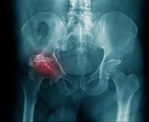 x-ray image hip avascular necrosis in blue tone 