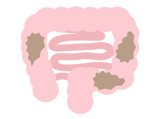 便秘の大腸