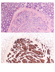 Photomicrograph of carcinoid tumor of the colon.  Upper panel stained with conventional H&E.  Lower...
