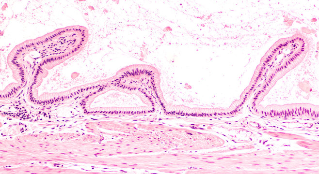 Cross section of a human gallbladder, from a patient with gallstones, showing simple columnar epithelium.