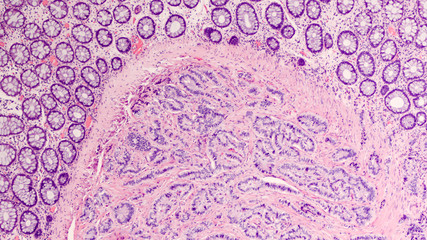 Photomicrograph of a carcinoid tumor, a type of neuroendocrine tumor (NET), which presented as a...